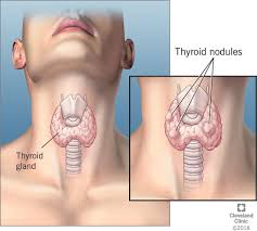 Thyroid 1