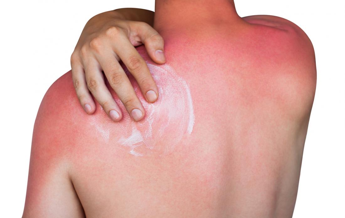 aromatherapy sunburn