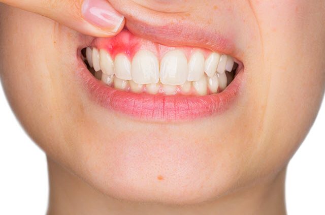 How-to-stop-bleeding-gums-ftd-640x423